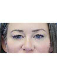 Upper Eyelid Crease Definition 5957