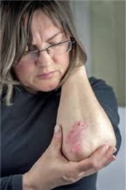 Psoriasis Lasionen An Besonderen Stellen Pz Pharmazeutische Zeitung