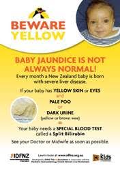 Jaundice In Babies Kidshealth Nz