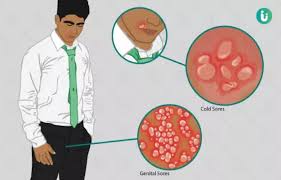 Herpes is caused by the herpes simplex virus. à¤¹à¤° à¤ª à¤¸ à¤• à¤²à¤• à¤·à¤£ à¤• à¤°à¤£ à¤‡à¤² à¤œ à¤¦à¤µ à¤‰à¤ªà¤š à¤° Herpes Simplex Virus Ke Karan Lakshan Ilaj Dawa Upchar In Hindi