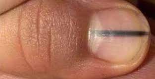 ) die de schimmel aantasten. Nagelstyliste Waarschuwt Voor Zwarte Streep Op Nagel