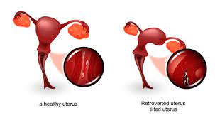 الرحم المقلوب الأسباب والأعراض والعلاج ويب طب