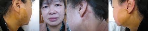 Modified face-lift approach combined with a superficially anterior and  superior-based sternocleidomastoid muscle flap in total p