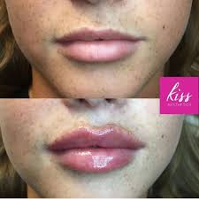 Celebrity Aestheticians On Instagram Russian Lip Lift By Dr Kaly Jaff Who Leads Our Scottish Clinics Glasgow Edinburgh