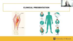Image result for Osteosarcoma
