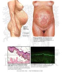 Image result for pruritic urticarial papules and plaques of pregnancy