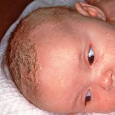 Image result for Cradle Cap