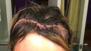 Use the staple extractor tool to slide underneath the outer part of the staple, twist slightly, or wiggle the tool until the staple comes out from the skin. How To Remove Surgical Staples From Your Head At Home Dr Dot Https Www Instagram Com Drdots Youtube