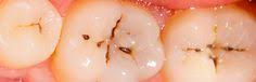 Comment Guerir Naturellement Les Caries Sante Nutrition Heal Cavities Tooth Decay Cure Tooth Decay