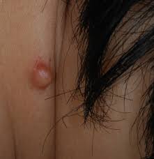 This hard lump may remain as such or complicate with time. Ingrown Hair Ingrown Hair On Vigina Lip