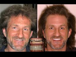 Before and after dentures implants. 21 Dental Implant Before And After Photos