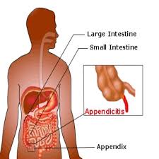 An Analysis Of Acute Appendicitis Symptoms Health Care Health Health Articles
