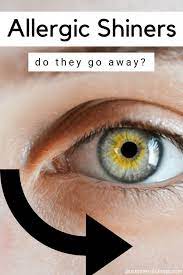 Do Allergic Shiners Go Away Allergy Eyes Eye Remedies Allergies