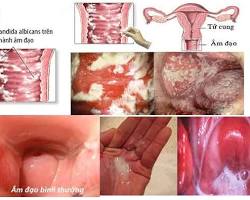 Hình ảnh về Viêm âm đạo  các triệu chứng