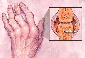 Visual Guide To Rheumatoid Arthritis
