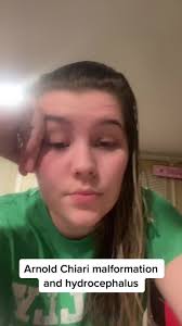 #brainsurgery #ArnoldChiarimalformation #hydrocephalus #severeheadaches  #fypシ #philly