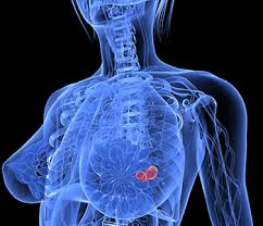 Essentially, mammograms turn a 3d object into a 2d object. 3d Technologies Poised To Change How Doctors Diagnose Cancers Fda