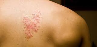 How To Naturally Treat Shingles Natural Health Remedies Natural Cures Natural Treatments