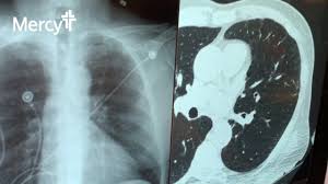 Ldct is proven to reduce lung cancer mortality. Ldct Scan Vs Traditional X Ray Youtube