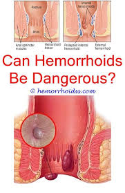 Internal hemorrhoids may protrude, or prolapse, through the anus. Pin On Treating Hemorrhoids