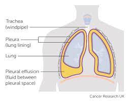 Even if you have symptoms, like a cough or feeling tired, you might not feel bad enough. Symptoms Of Advanced Cancer Lung Cancer Cancer Research Uk