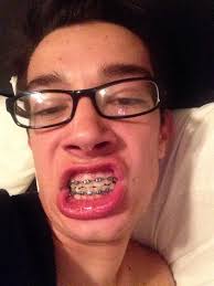 Over time you will be able to see your smile starting to change. James Charles On Twitter Beyoncebeytwice I M Getting My Braces Off In 2 Days Omg Http T Co Tos8do4u4i