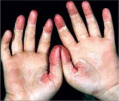 It may occur in various skin conditions. Jaypeedigital Ebook Reader