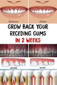Receding Gums Grow Back Your Receding Gums In 2 Weeks Gum Disease Remedies Gum Health Receding Gums