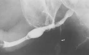 Image result for Retrograde Urethrogram