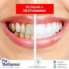 Özel serteser ağız diş sağlığı polikliniği afyonkarahisar. Afyon Ballipinar Agiz Ve Dis Sagligi Poliklinigi Sur Twitter Dis Taslari Kanamanin Onde Gelen Nedenidir Dis Taslarindan Tamamen Temizlenmis Dislerde Yeniden Olusmasi Icin Gerekli Sure 48 Saattir Agiz Ortaminda Tukuruk Mikroplar