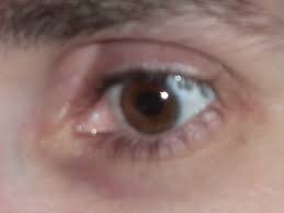 Home care plans risk for bleeding nursing care plan. Nursing Care Plan And Diagnosis For Risk For Injury Related To Diplopia Nanda Nursing Interventions And Outcomes Goals