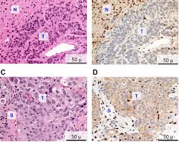 H E And Immunohistochemical Staining Of Meningioma And Mesothelioma Download Scientific Diagram