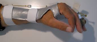 Les douleurs de la main peuvent avoir diverses origines : Lexique Service De Chirurgie Plastique Et De La Main Chuv