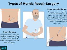 Hernia Repair Surgery: Purpose, Recovery, And More