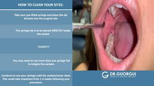 Feb 28, 2021 · how long until my wisdom teeth holes close february 28, 2021 how to identify and deal with a dry socket dodging the dreaded dry socket on last molar extracted do i need a why even have missing teeth replaced wisdom teeth removal tooth Post Operative Video Irrigation For Extraction And Wisdom Teeth Youtube