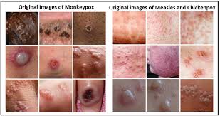 Image result for Monkeypox