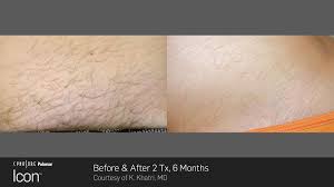 As we all know, electrolysis is a lengthy process, and a certain amount of regrowth is part of that process. Laser Hair Removal Jacksonville Fl Premier Medical Spa