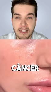 O câncer de pele é o câncer mais comum do mundo, e atinge pessoas de todas  as idades e cores de pele. Na grande maioria dos casos é de fácil  tratamento, principalmente se diagnosticado cedo. Porém, ...