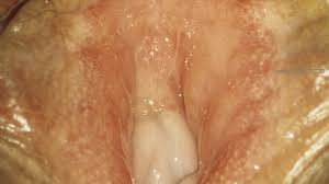 Extremes jucken und danach brennen, weil ich ja kratzen musste und. Vulva Altmeyers Enzyklopadie Fachbereich Dermatologie