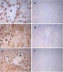 Learn more about diagnosis, staging and treatment. Treatment Of Malignant Pleural Mesothelioma By Fibroblast Activation Protein Specific Re Directed T Cells Journal Of Translational Medicine Full Text