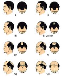 The hair also starts to lose its color. Natural Remedies For Hair Loss Michael Edwards Elephant Journal Hair Loss Remedies Hair Loss Men Mens Hair Loss Remedies