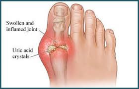 Image result for gout