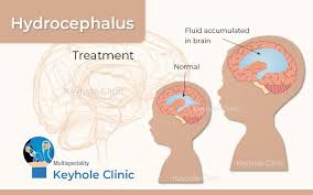 Image result for Hydrocephalus