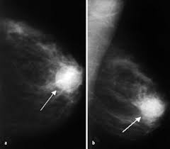 Radiologische Diagnostik Des Mammakarzinoms Springerlink
