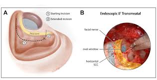 Image result for Ossicular Chain Disruption