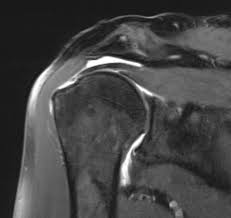 Schulterschmerzen Dr Med Roman Winkler Orthopadie Unterhaching