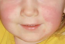 Hautausschlag − eine reaktion des körpers auf schädliche einflüsse. Scharlach Von Mild Bis Fulminant Medonline