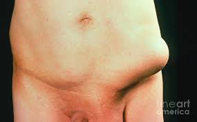 Image result for Inguinal hernia man
