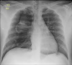 What causes a pneumothorax in children? Pneumothorax News Papers