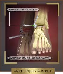 The talus is the bone at the top of the foot. Talus Fracture After An Accident